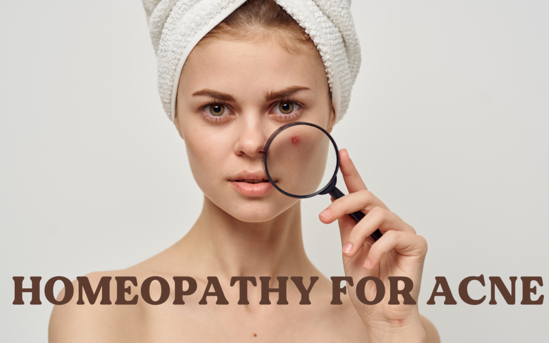 Homeopathy for Acne