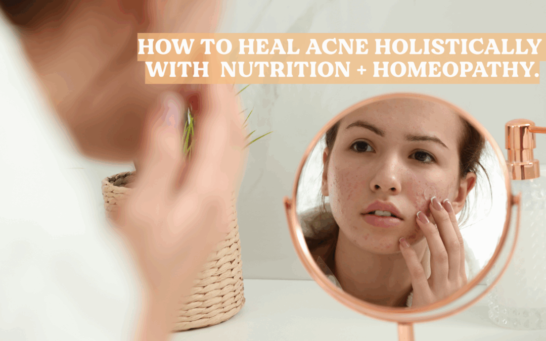 How to Heal Acne Holistically with Nutrition + Homeopathy.